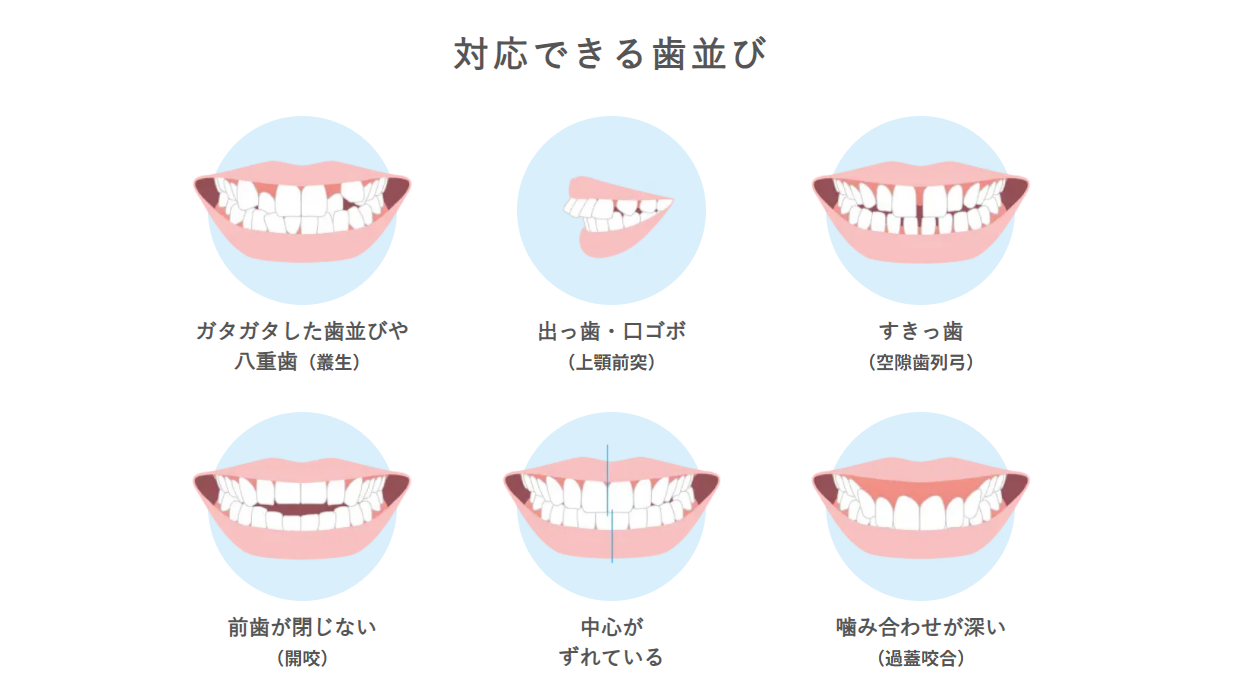 ><br />
スマイルモア矯正は、前歯のガタつきやすき間など、笑ったときに気になりやすい部分の歯並びを相談しやすいマウスピース矯正です。</p>
<p><span class=