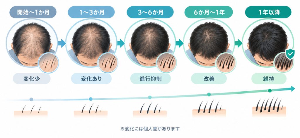 フィナステリド服用開始後の髪の変化